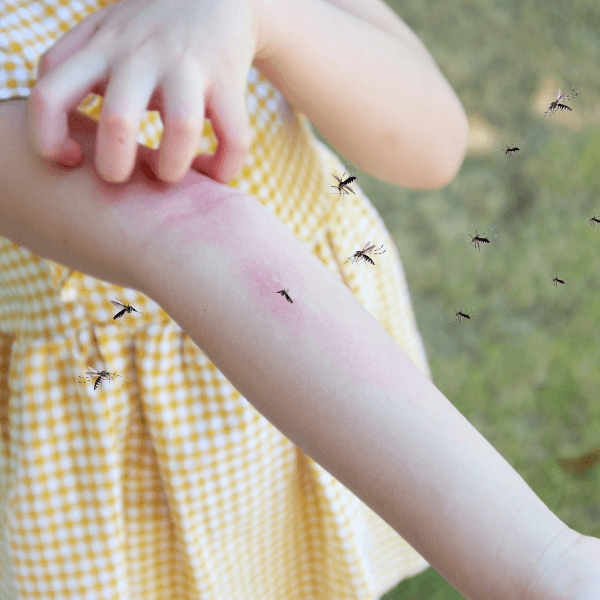 Allergic Reactions to Mosquito Bites